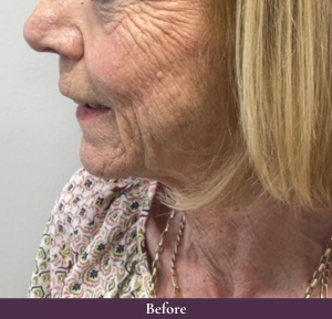 Cheek dermal filler in Thanet at C.H.L
