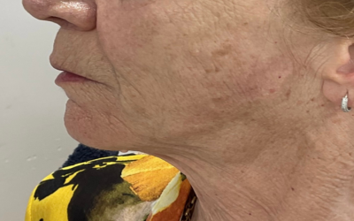 Cheek Dermal Fillers in Thanet