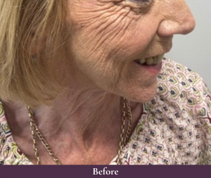 Cheek dermal fillers in Kent by C.H.L