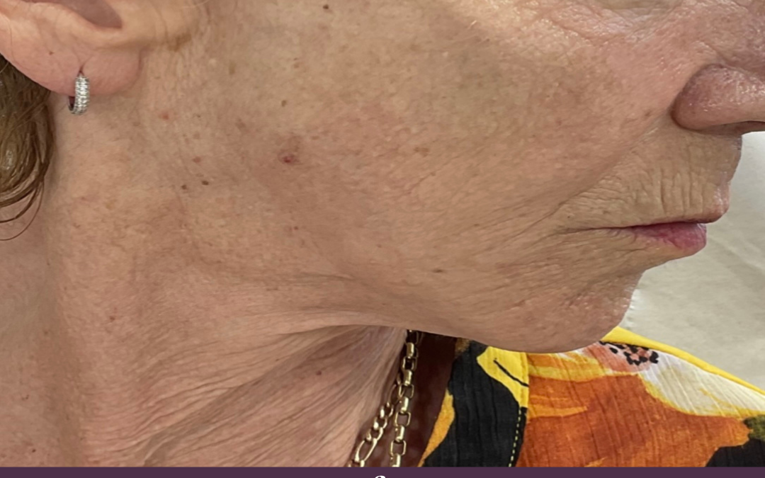 Cheek Dermal Fillers in Kent