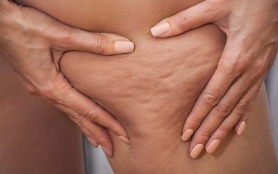 Discover a new solution for cellulite in Margate