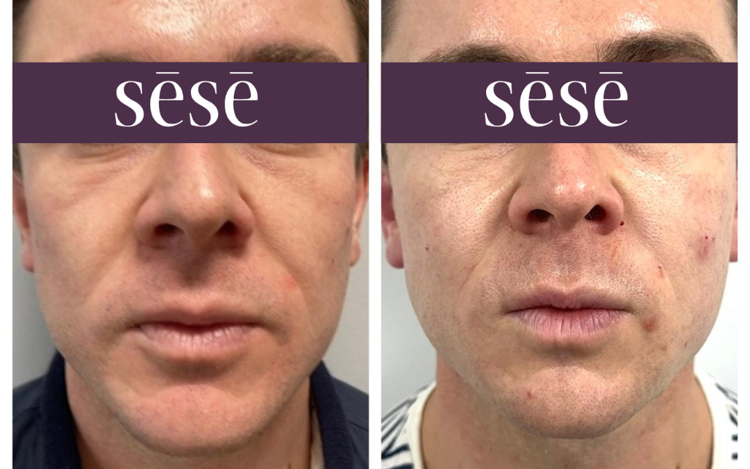 Jaw Filler – Aesthetics Clinic in Kent