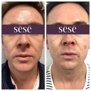 Jaw filler at C.H.L