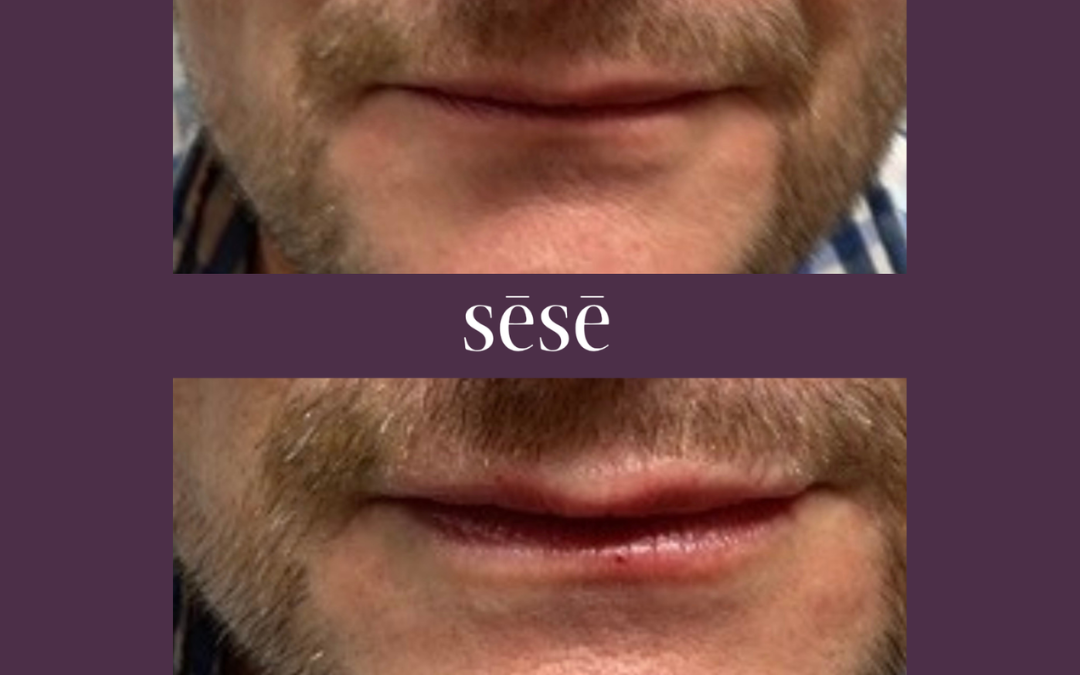 Male Lip Filler in Kent
