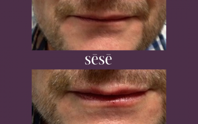 Male Lip Filler in Kent