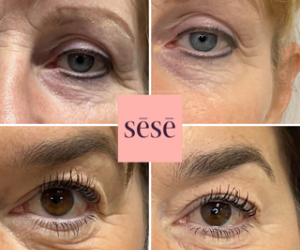 Under Eye Wrinkle Treatment at C.H.L