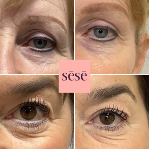 Under eye wrinkle treatment at C.H.L