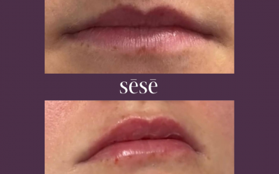 Lip Filler Before and After – C.H.L