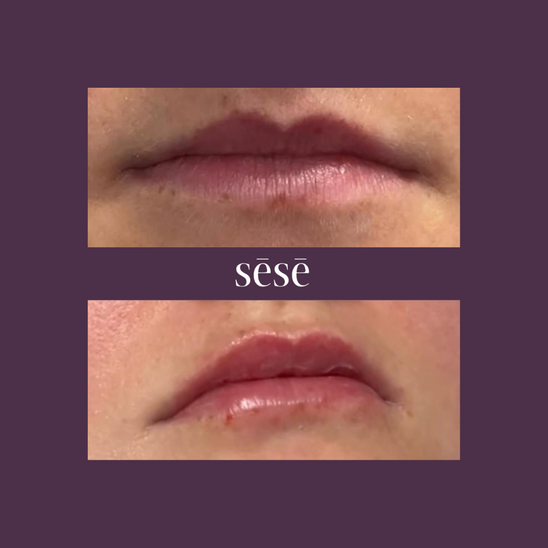 Untitled design (15) Lip Filler before and after at C.H.L