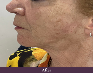 Cheek dermal fillers