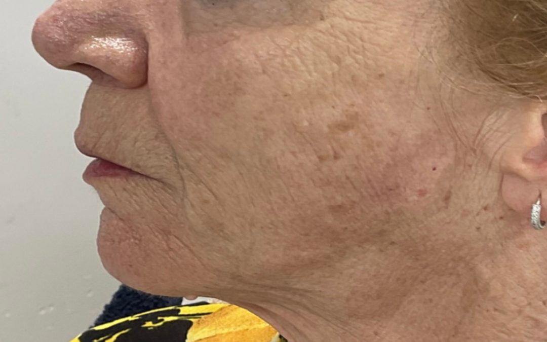 Cheek Dermal Fillers