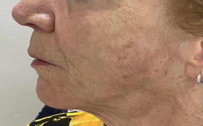 Cheek Dermal Fillers