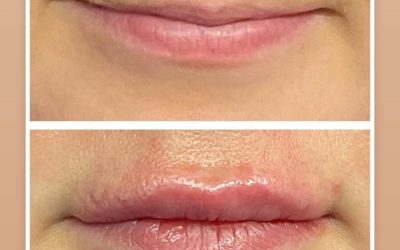 Lip Filler Services in Kent