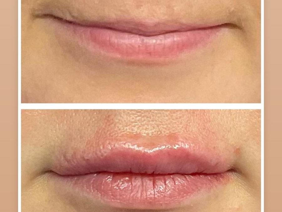 Lip Filler Services in Kent