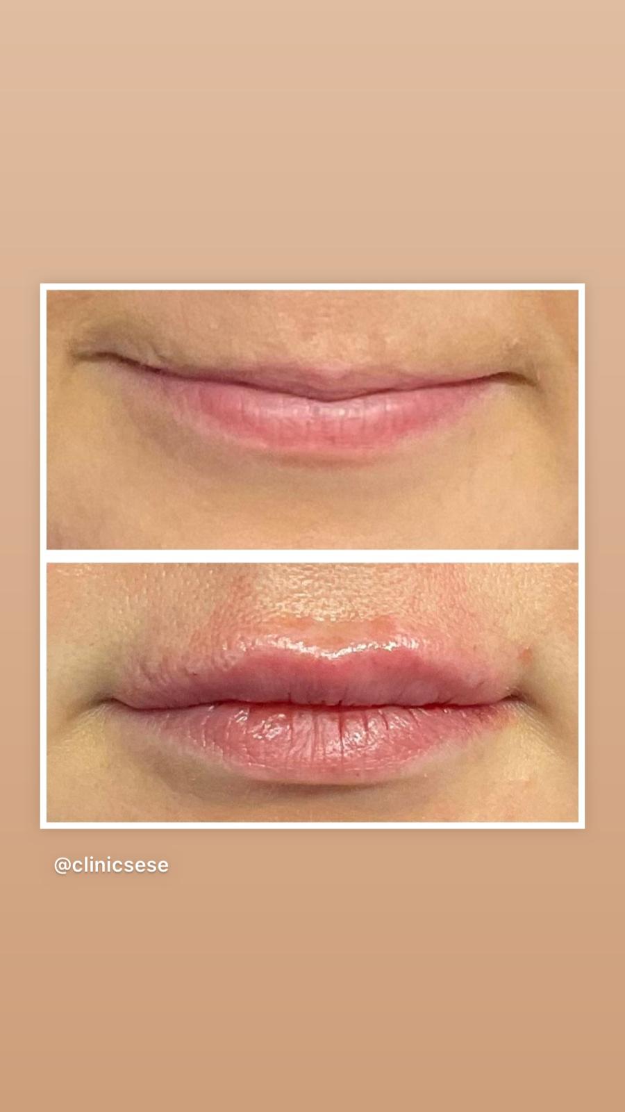 Lips Lip Filler Services in Kent
