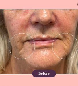 Marionette lines treatment