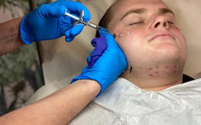 Dermal Filler Services in Kent
