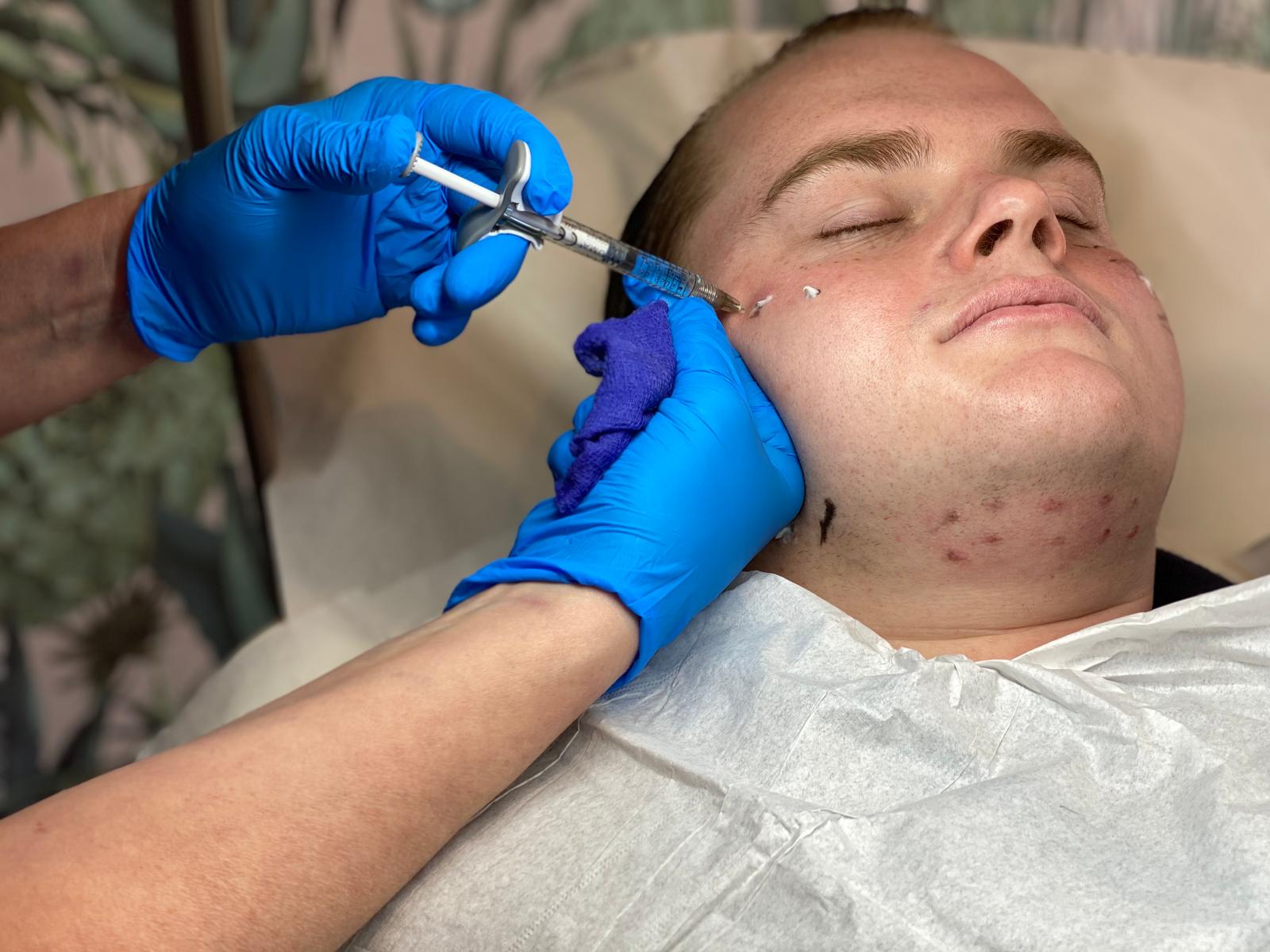 face syringe Dermal Filler Services in Kent