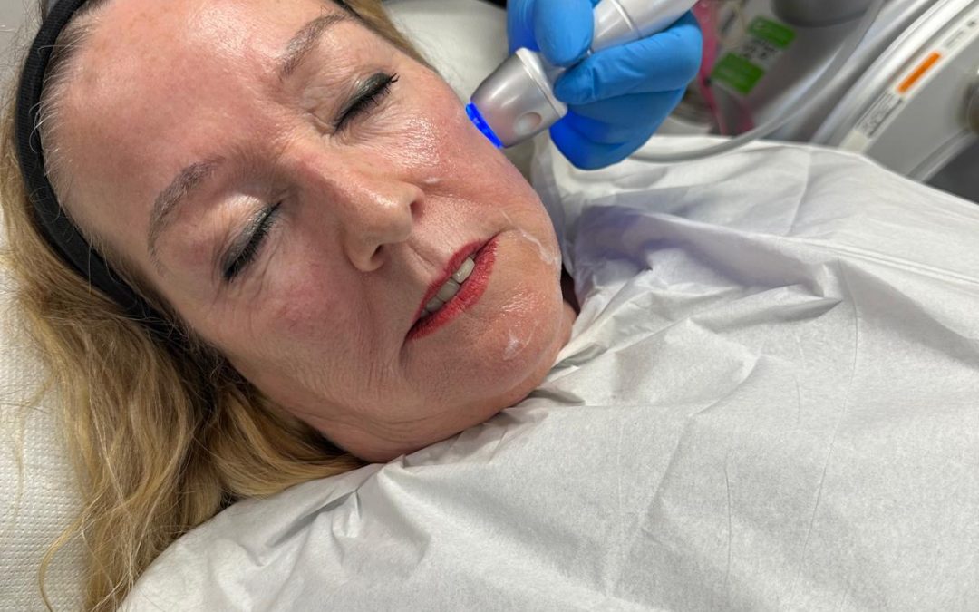 Radio Frequency Skin Tightening in Kent