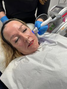 Radio Frequency Skin Tightening 
