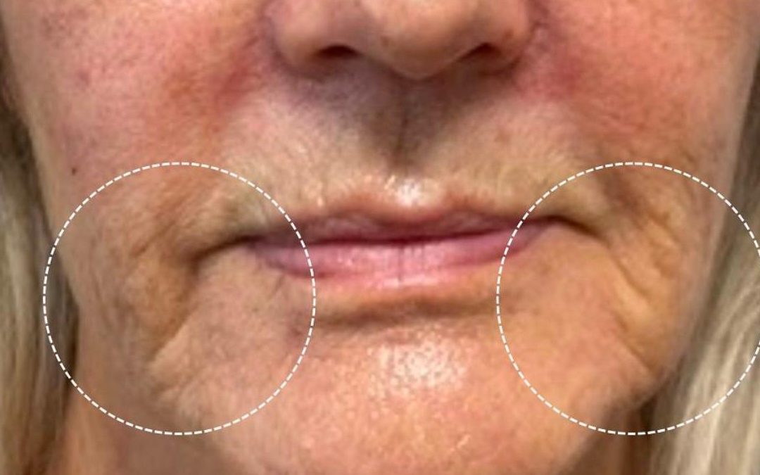 Marionette Lines Treatment